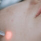 Traiter la rosacée et la couperose au laser : une solution efficace contre les rougeurs du visage