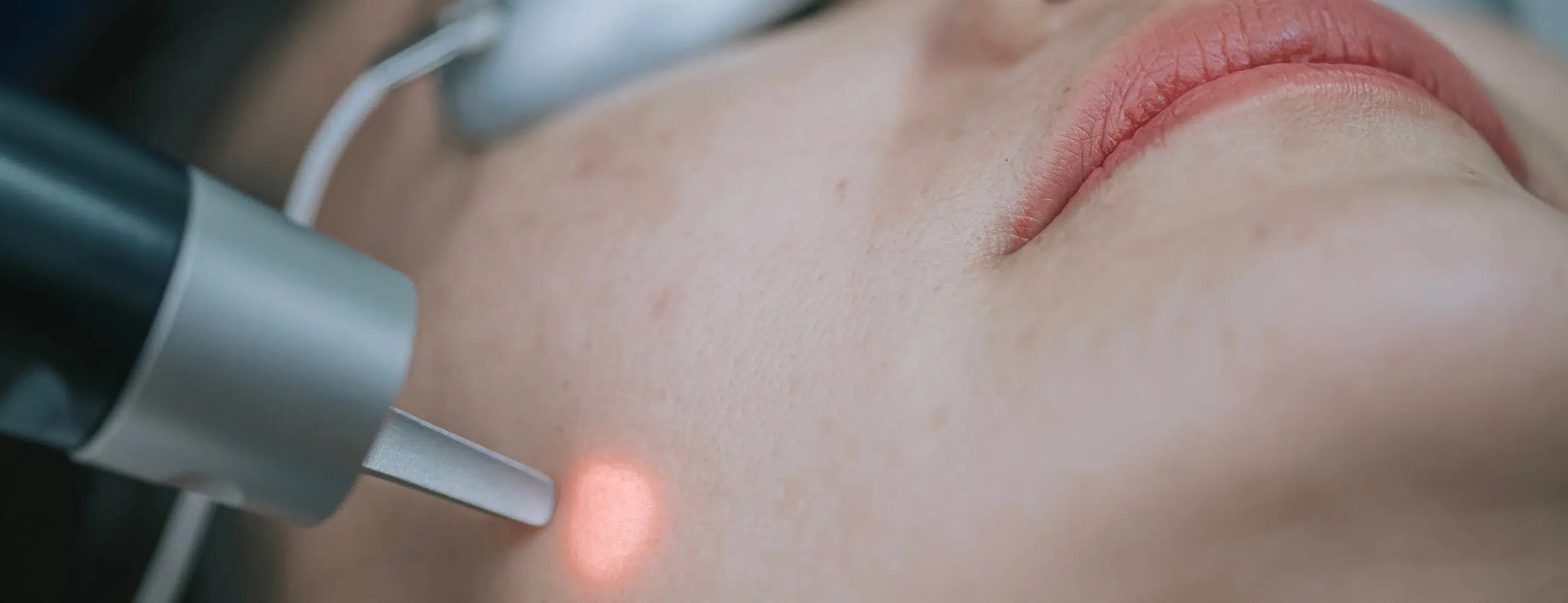 Rosacée et couperose au laser