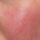 Couperose ou simple rougeur : comment faire la différence ?